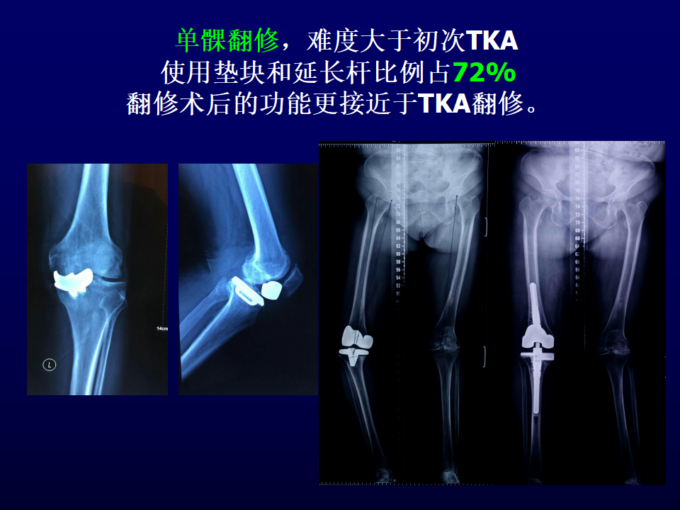 单髁置换术治疗膝关节骨性关节炎