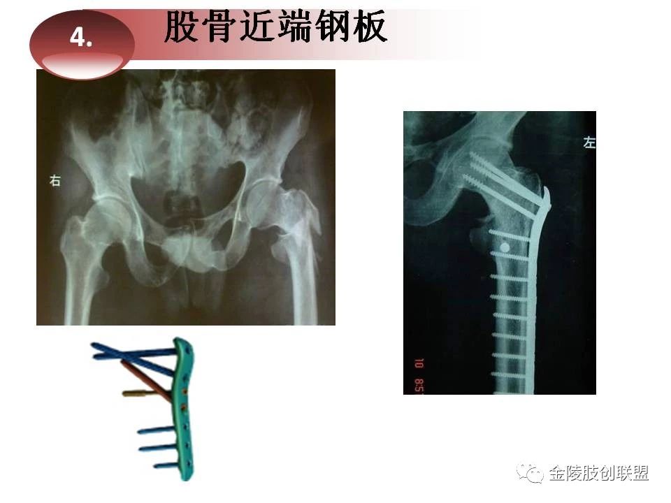 股骨转子间骨折的分型及内固定选择