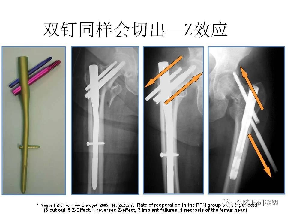 股骨转子间骨折的分型及内固定选择