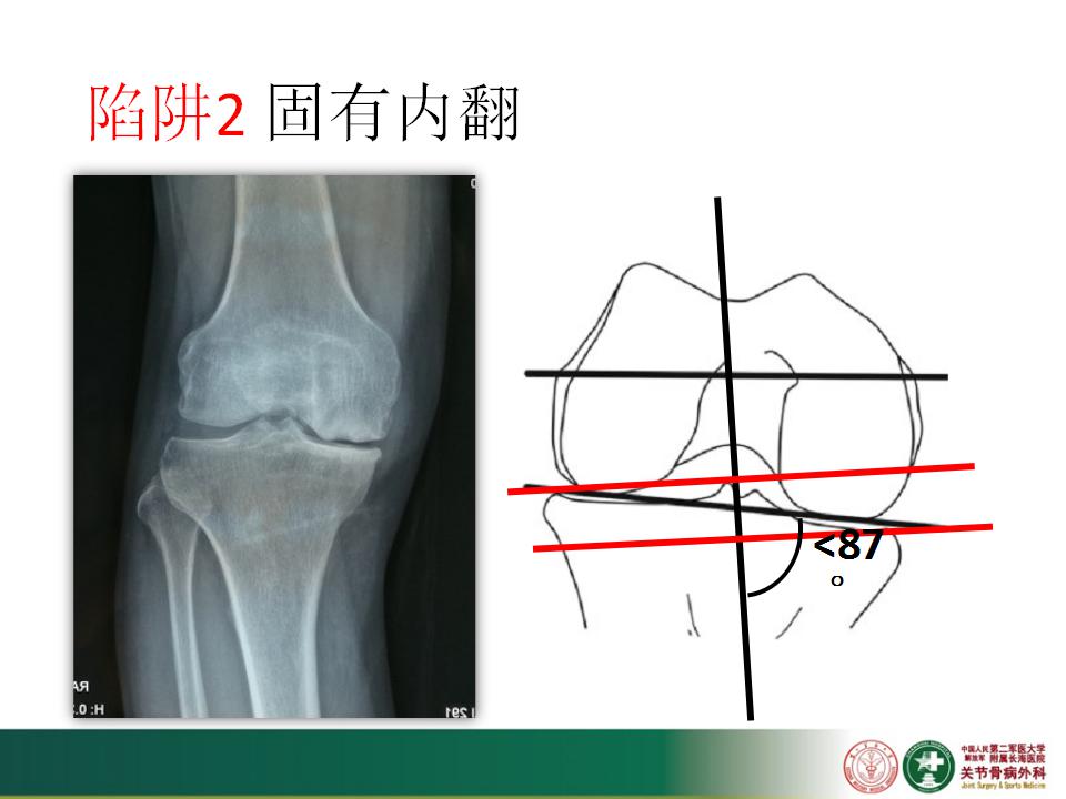 徐卫东—初次膝关节置换手术要点讲解！