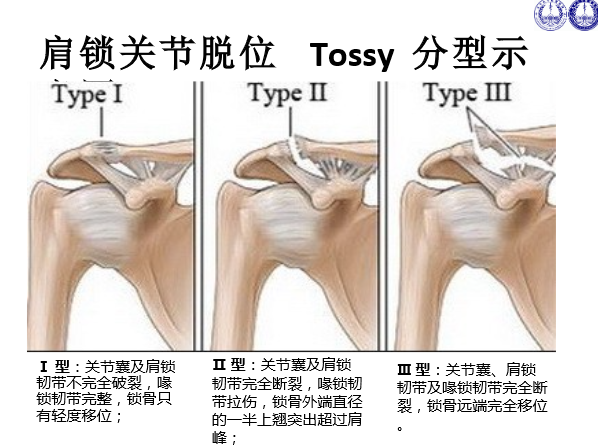 肩锁关节脱位的诊断与治疗