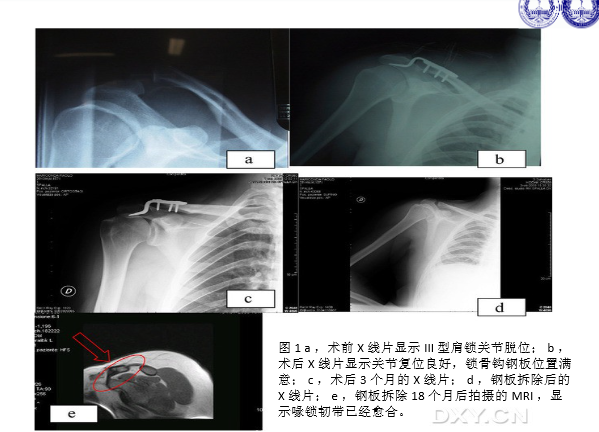 肩锁关节脱位的诊断与治疗