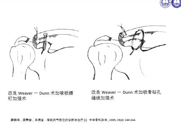 肩锁关节脱位的诊断与治疗