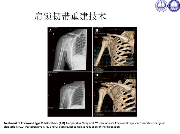 肩锁关节脱位的诊断与治疗