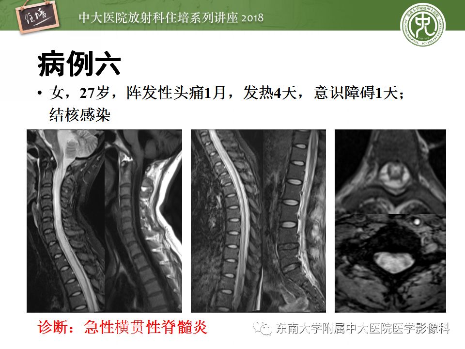8个病例详解「脊髓内最常见疾病」的MR诊断