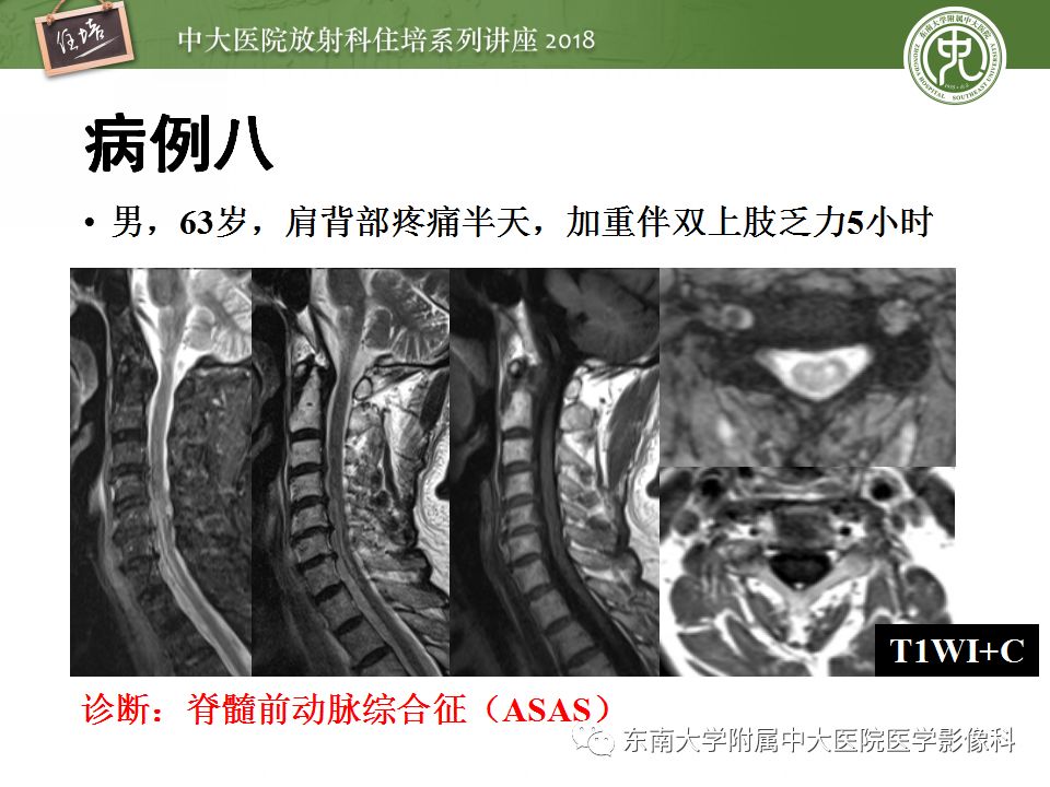 8个病例详解「脊髓内最常见疾病」的MR诊断