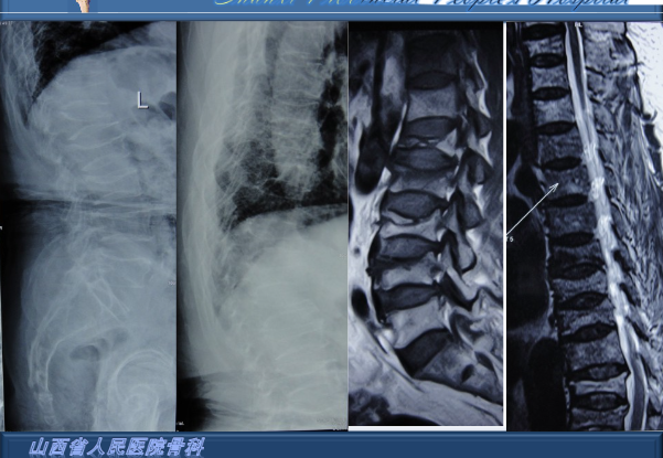 透彻解析：骨质疏松椎体压缩性骨折的治疗策略