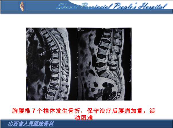 透彻解析：骨质疏松椎体压缩性骨折的治疗策略