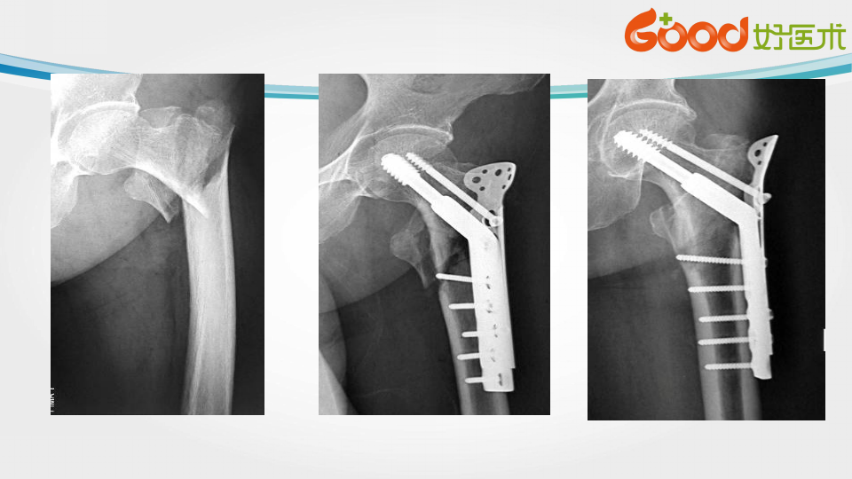 股骨转子间骨折的治疗方法及手术技巧