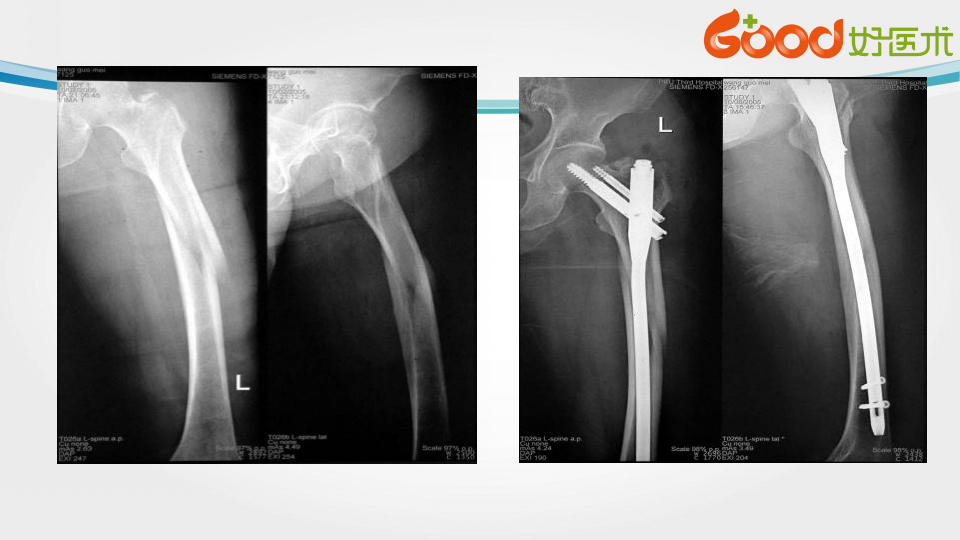 股骨转子间骨折的治疗方法及手术技巧