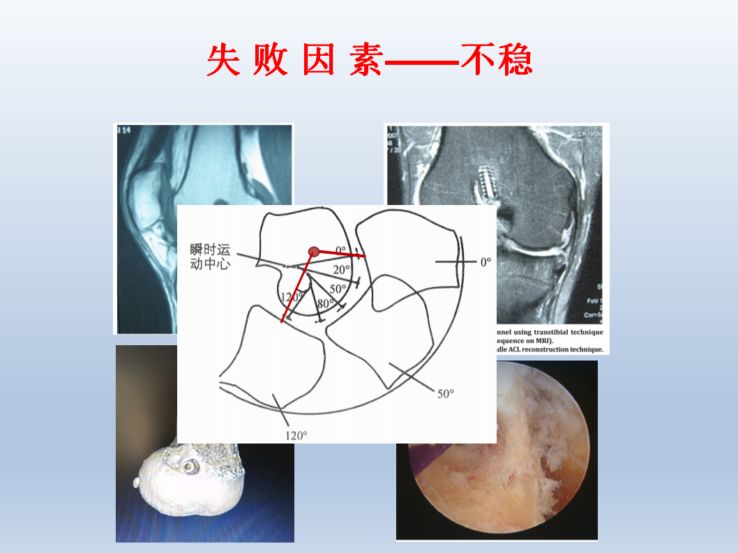 ACL为什么会重建失败，看看这篇！