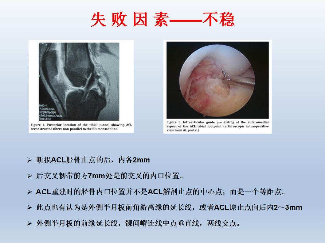 ACL为什么会重建失败，看看这篇！