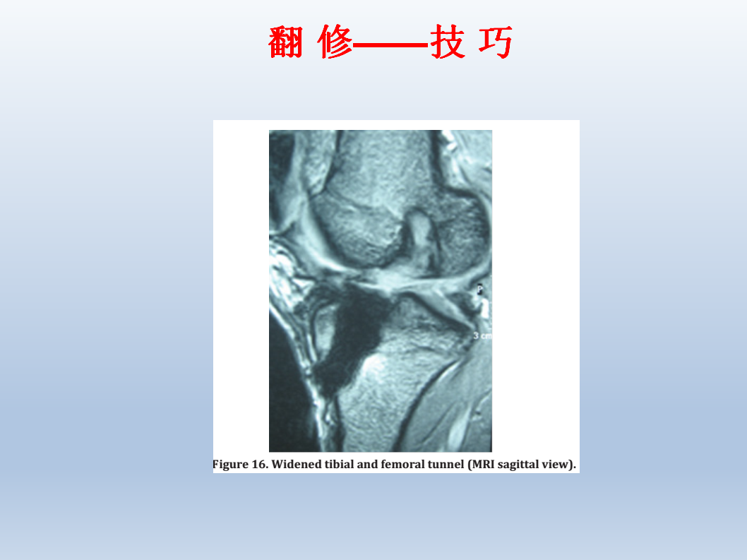 ACL为什么会重建失败，看看这篇！