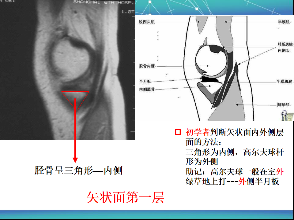 膝关节半月板MRI诊断，看这篇就够了！