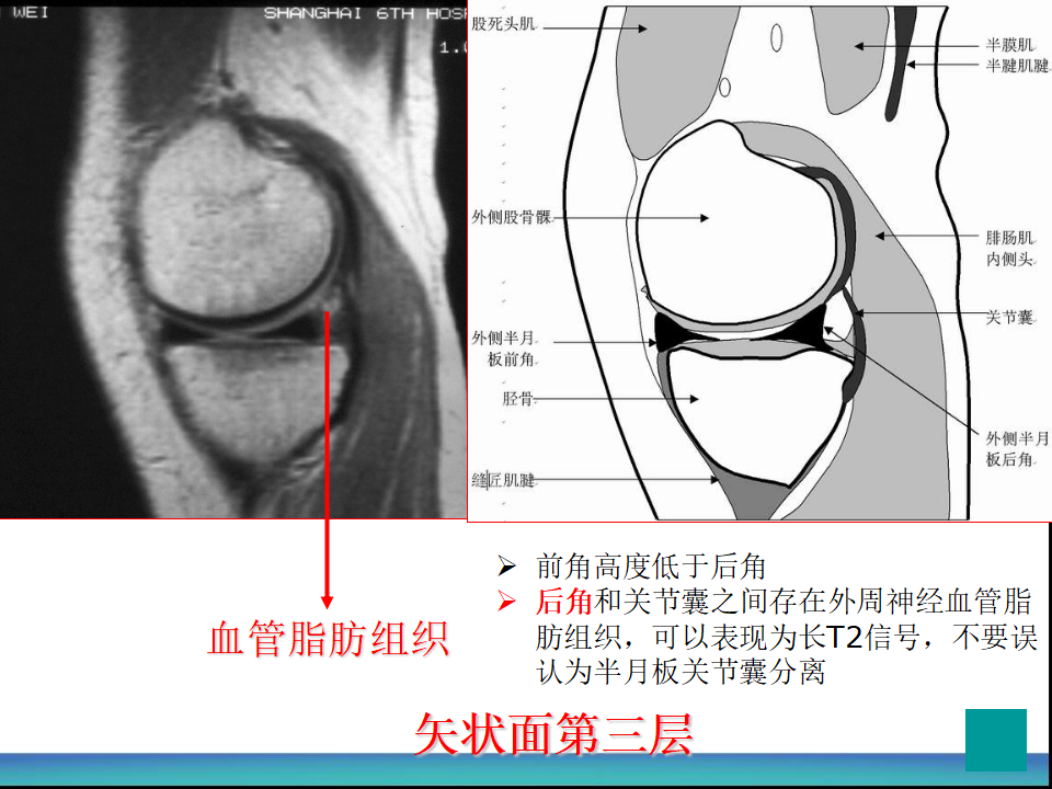 膝关节半月板MRI诊断，看这篇就够了！