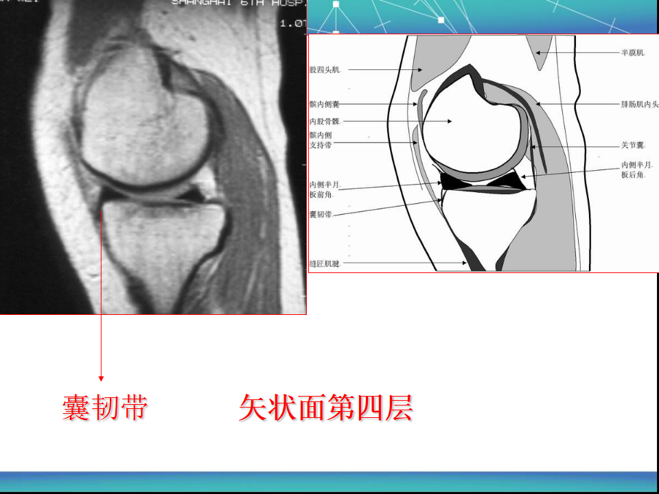 膝关节半月板MRI诊断，看这篇就够了！