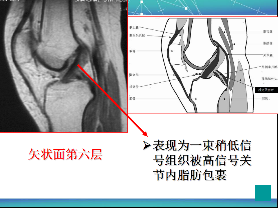 膝关节半月板MRI诊断，看这篇就够了！