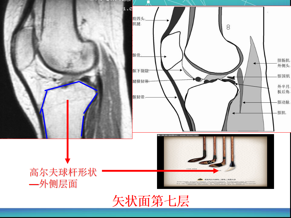 膝关节半月板MRI诊断，看这篇就够了！