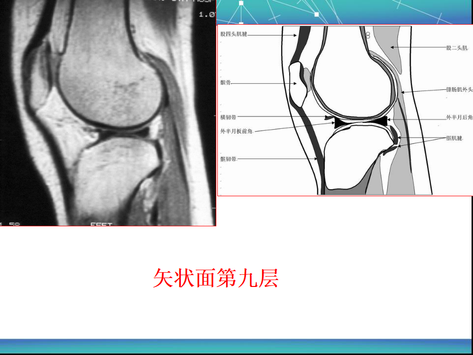 膝关节半月板MRI诊断，看这篇就够了！