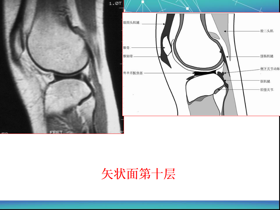 膝关节半月板MRI诊断，看这篇就够了！