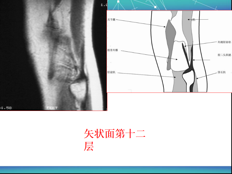 膝关节半月板MRI诊断，看这篇就够了！