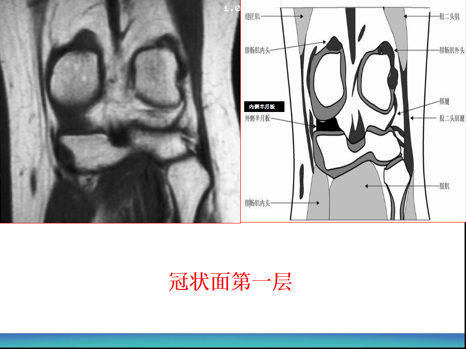 膝关节半月板MRI诊断，看这篇就够了！