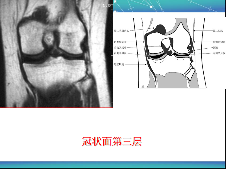 膝关节半月板MRI诊断，看这篇就够了！