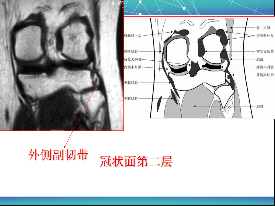 膝关节半月板MRI诊断，看这篇就够了！