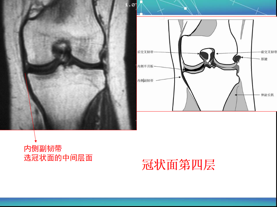 膝关节半月板MRI诊断，看这篇就够了！