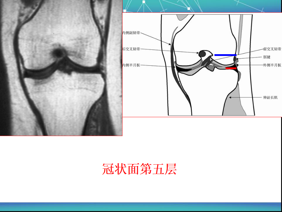 膝关节半月板MRI诊断，看这篇就够了！