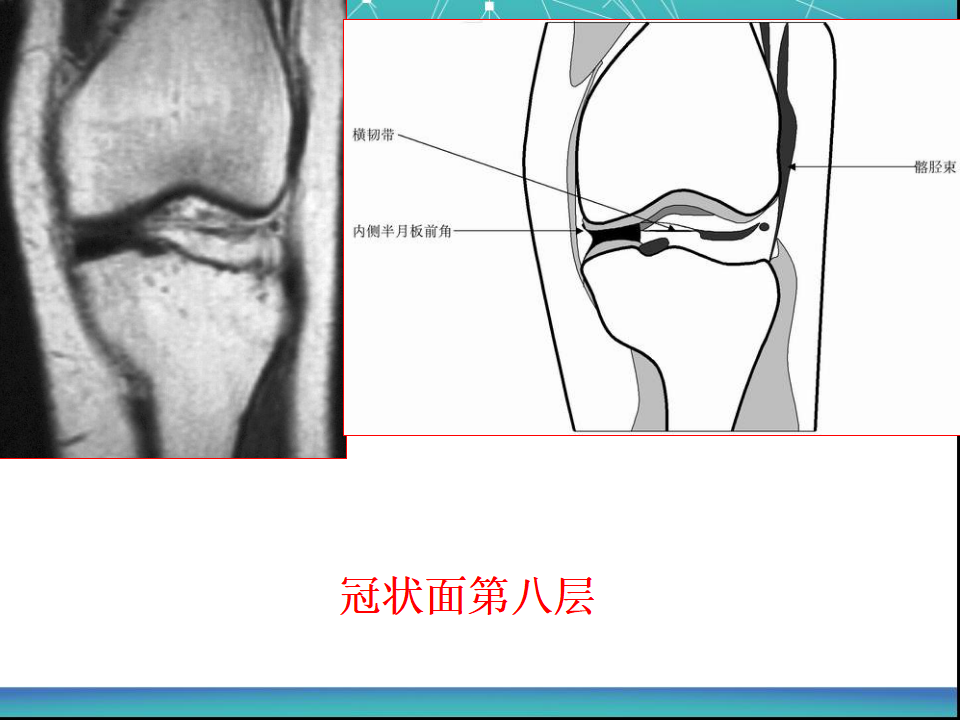 膝关节半月板MRI诊断，看这篇就够了！