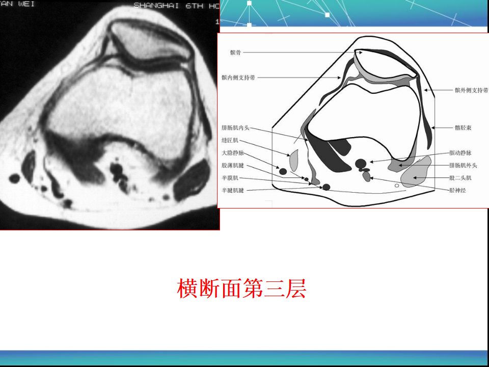 膝关节半月板MRI诊断，看这篇就够了！