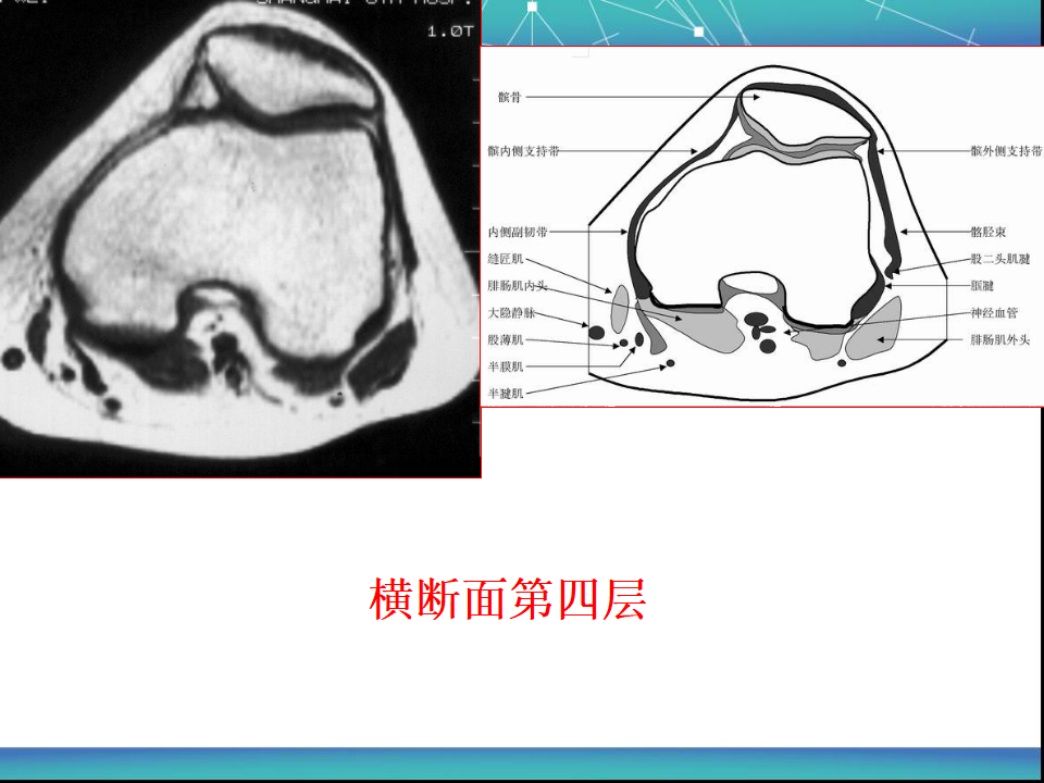 膝关节半月板MRI诊断，看这篇就够了！