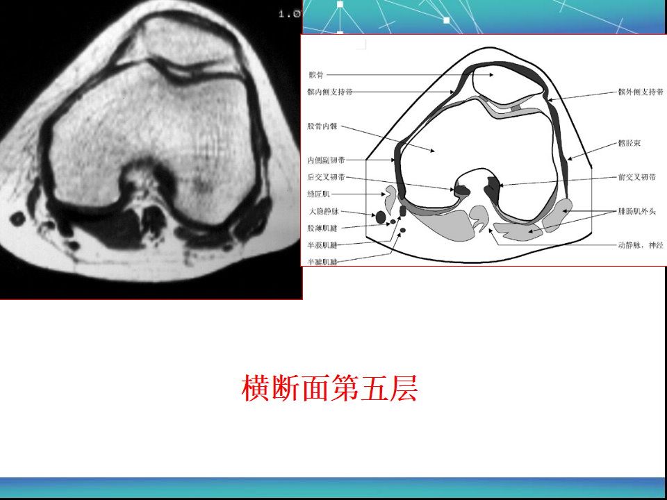 膝关节半月板MRI诊断，看这篇就够了！