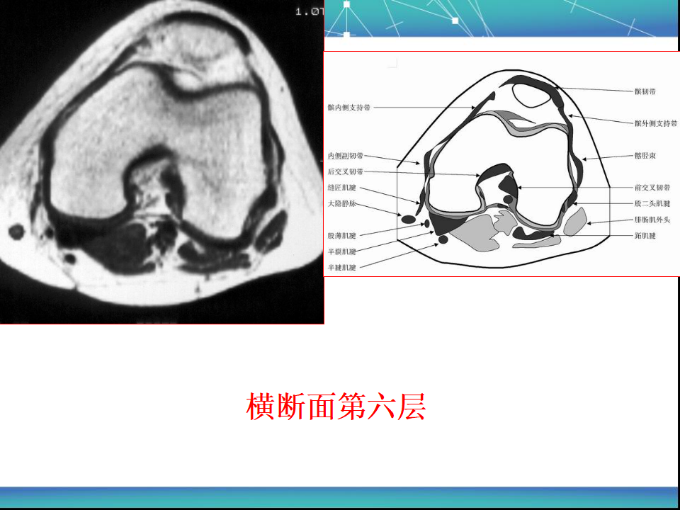 膝关节半月板MRI诊断，看这篇就够了！