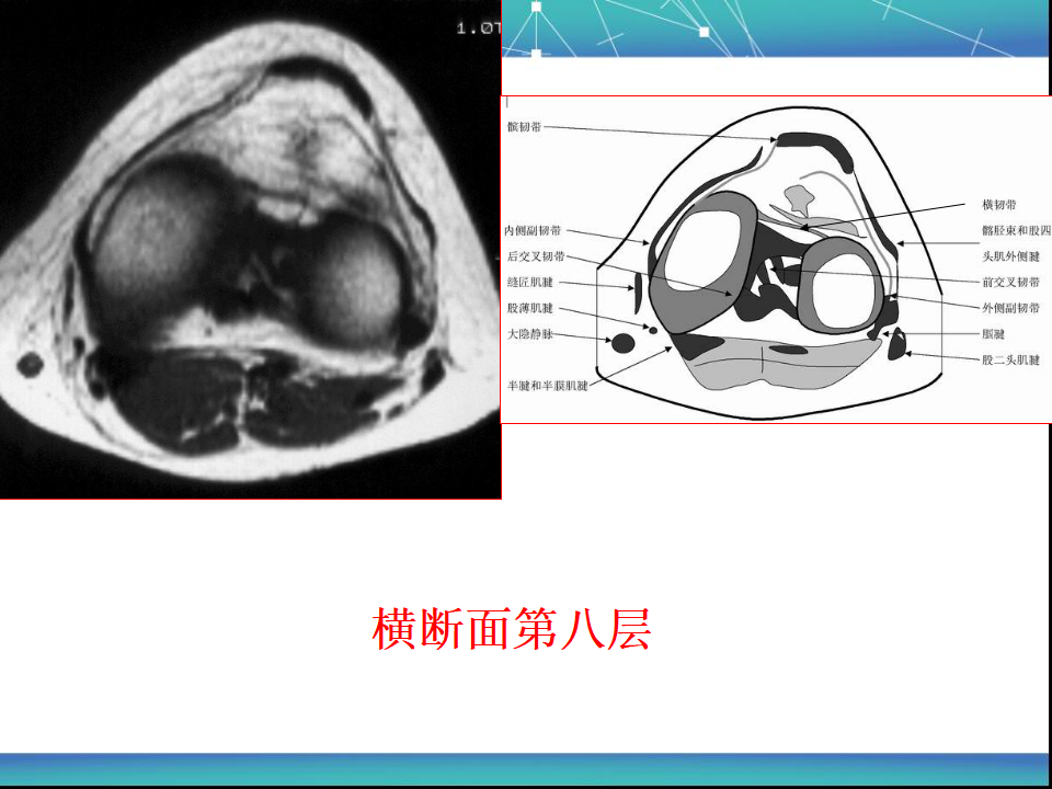 膝关节半月板MRI诊断，看这篇就够了！