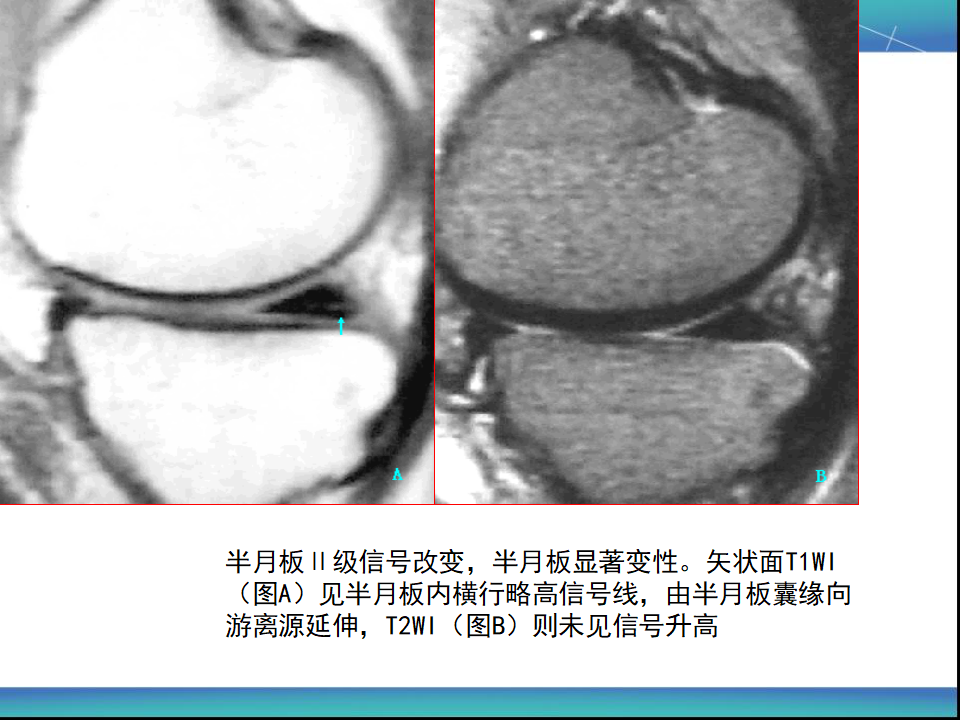 膝关节半月板MRI诊断，看这篇就够了！