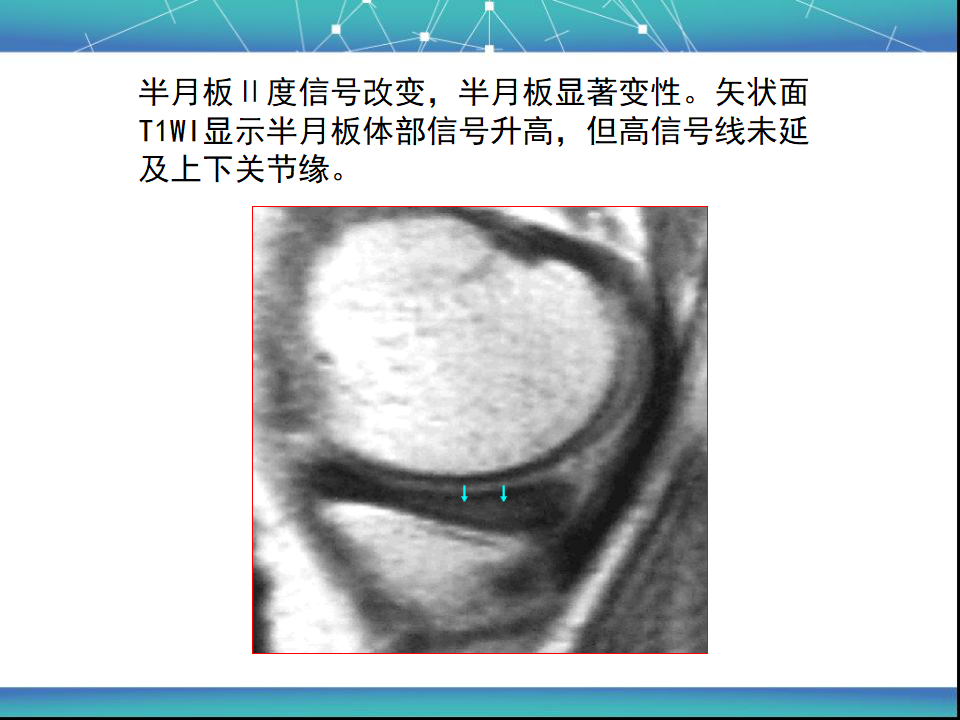 膝关节半月板MRI诊断，看这篇就够了！