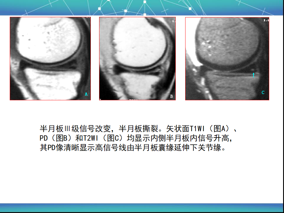 膝关节半月板MRI诊断，看这篇就够了！