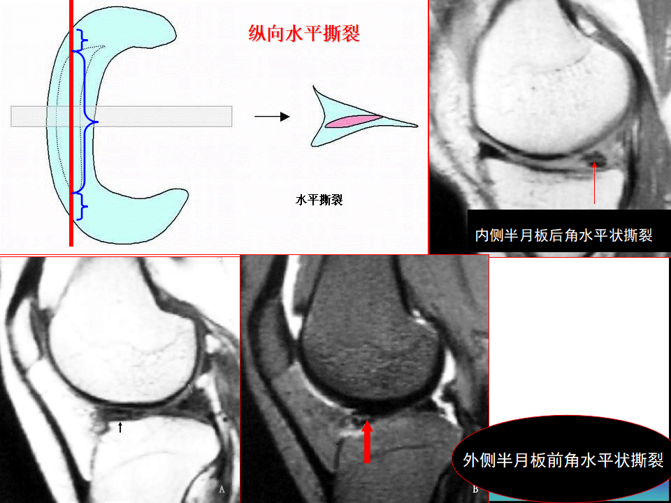 膝关节半月板MRI诊断，看这篇就够了！