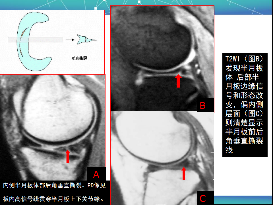 膝关节半月板MRI诊断，看这篇就够了！