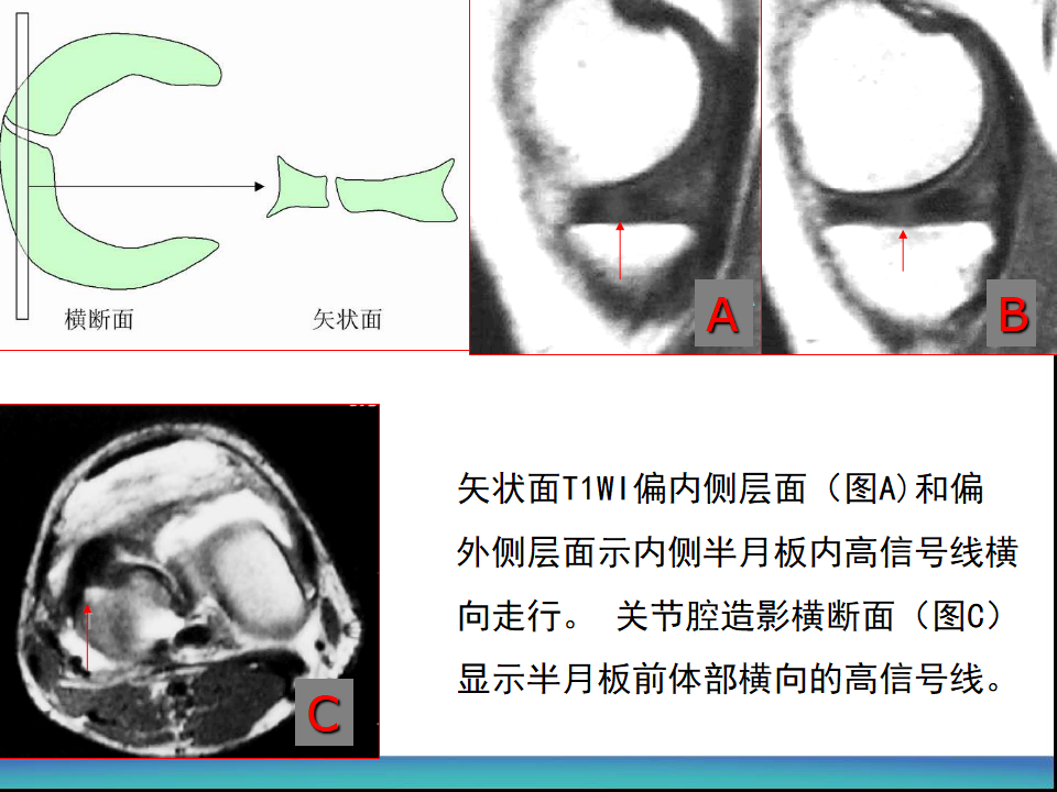 膝关节半月板MRI诊断，看这篇就够了！