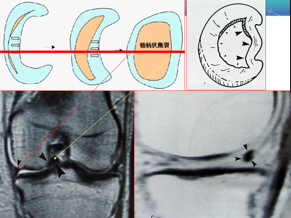 膝关节半月板MRI诊断，看这篇就够了！