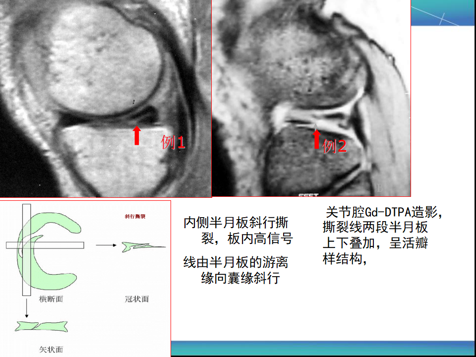 膝关节半月板MRI诊断，看这篇就够了！