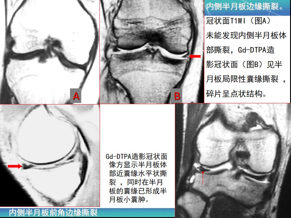 膝关节半月板MRI诊断，看这篇就够了！