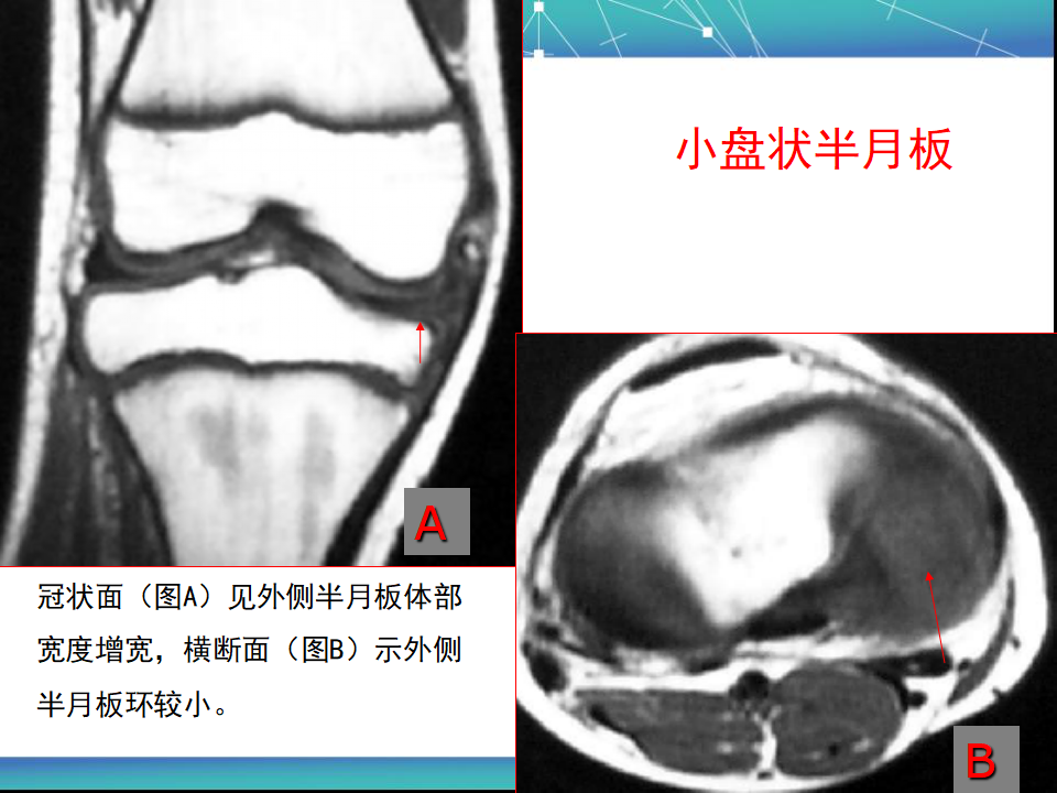 膝关节半月板MRI诊断，看这篇就够了！