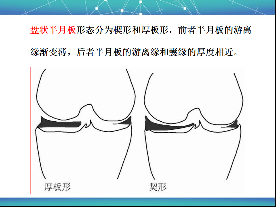 膝关节半月板MRI诊断，看这篇就够了！