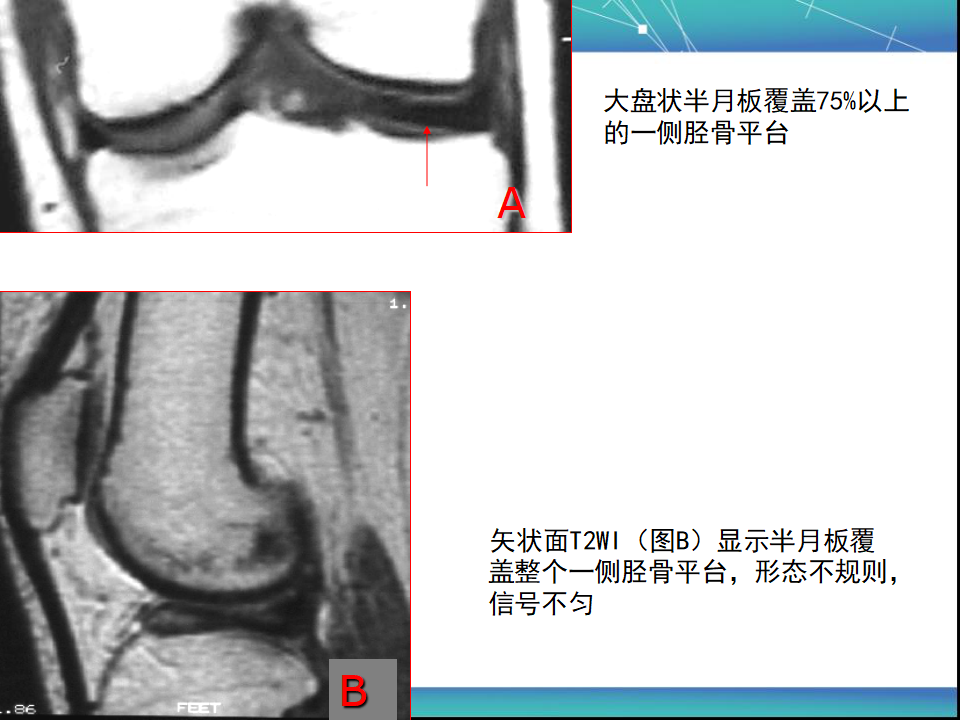 膝关节半月板MRI诊断，看这篇就够了！