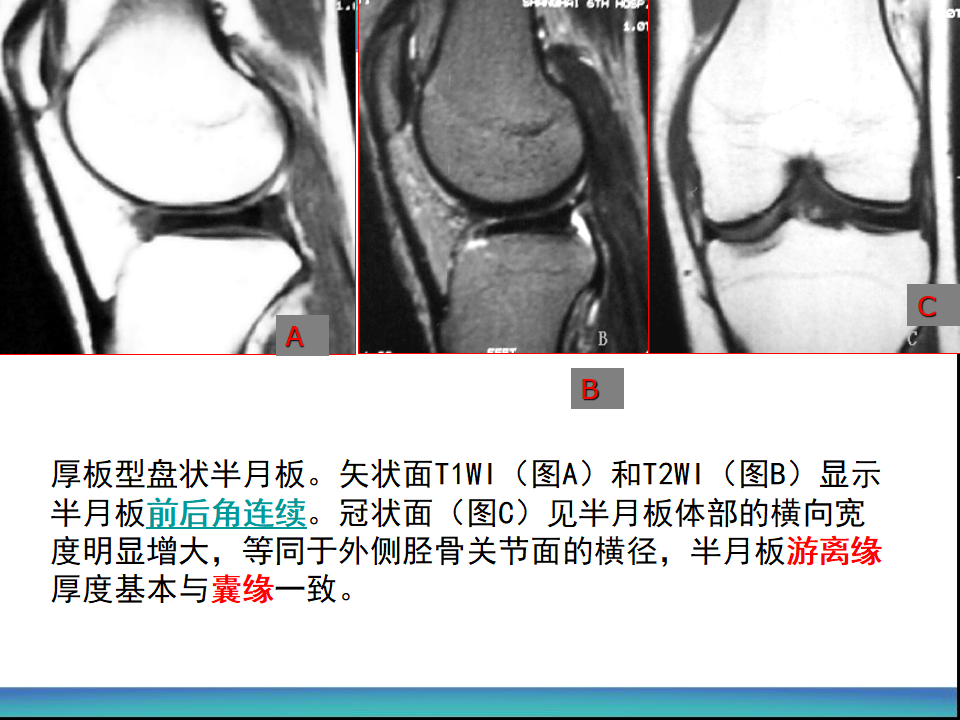 膝关节半月板MRI诊断，看这篇就够了！