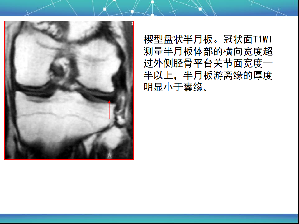 膝关节半月板MRI诊断，看这篇就够了！